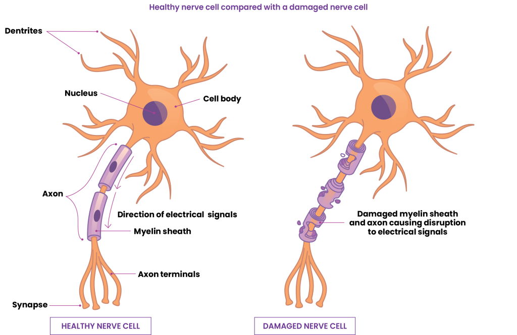 Microscopic comparison: healthy nerve cell vs. neuropathy-affected nerve cell